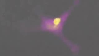 T-Cell destroys a cancer cell.