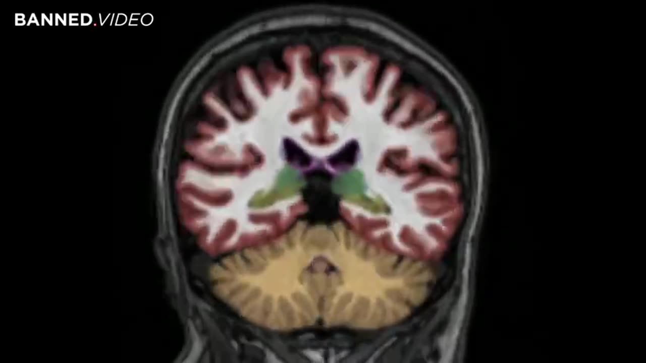Estudio demuestra la realcion ente CAMPOS ELECTROMAGNETICOS y el ALZHEIMER