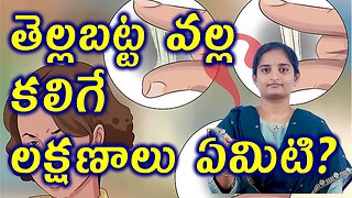తెల్లబట్ట వల్ల కలిగే లక్షణాలు Leucorrhea White Discharge Symptoms In Women Homeopathy Treatment Cure