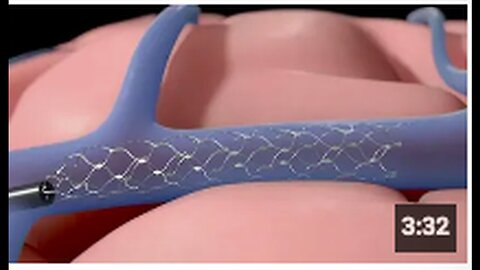 "FDA Approves Synchron's Brain-Computer Interface for Human Trials in Transhumanism Advance"