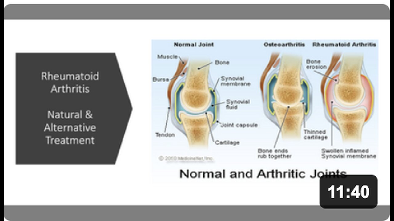 Rheumatoid Arthritis - Natural & Alternative Treatment