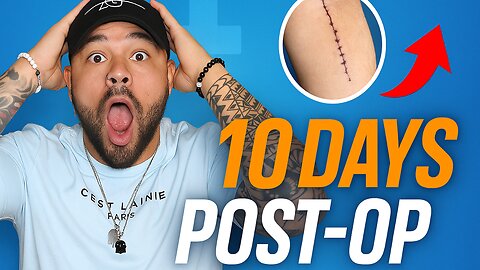 10 Days Post ACL Cadaver Graft Reconstruction Surgery | Recovery Update