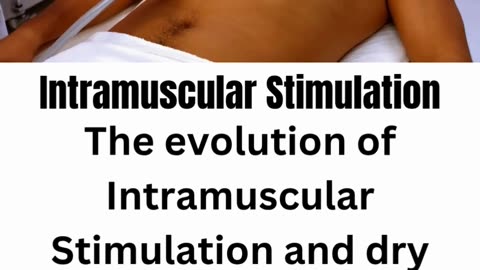 Intramuscular Stimulation (IMS) | DivineCare Physiotherapy Langley BC
