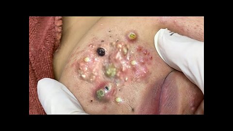 blackhead removal and Pimplepopper Spa relaxation #10125