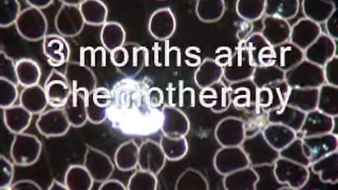 "Blood Analysis Post-Chemotherapy: A Live Observation"