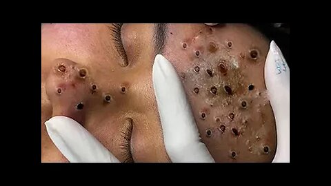 ACNE BLACKHEADS WHITEHEADS REMOVAL on face | How to get rid of pimple easy part