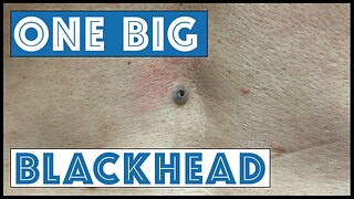 One Big Blackhead aka Dilated Pore of Winer