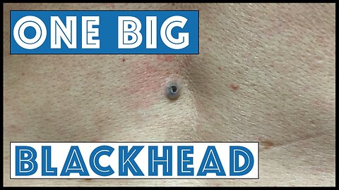One Big Blackhead aka Dilated Pore of Winer