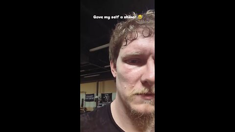 Black eye - Dropped the bar on my face 😂