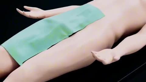 Enlarged Prostate Treatments (3D Animation)