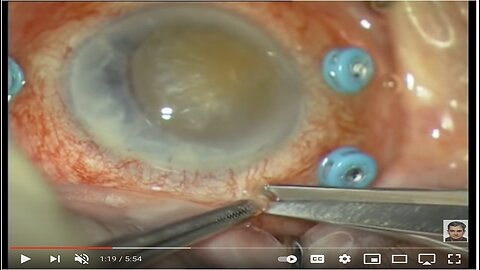 Weird Discovery That Restores Perfect Vision