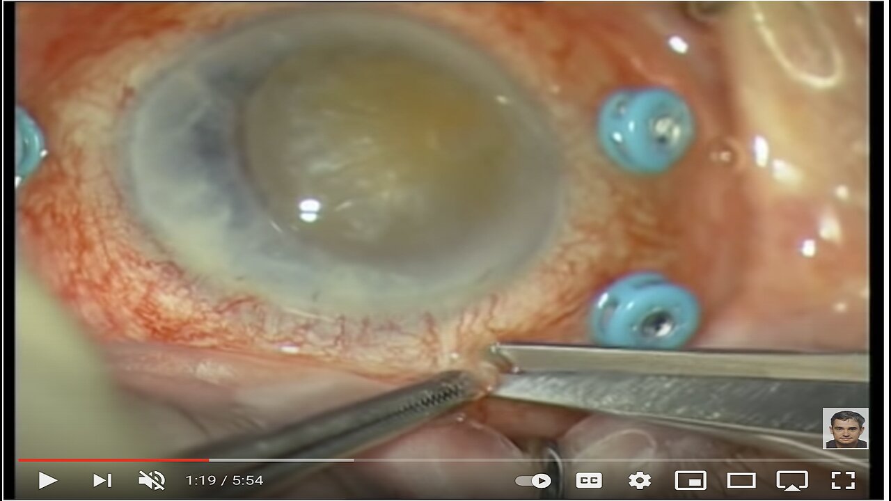 Weird Discovery That Restores Perfect Vision