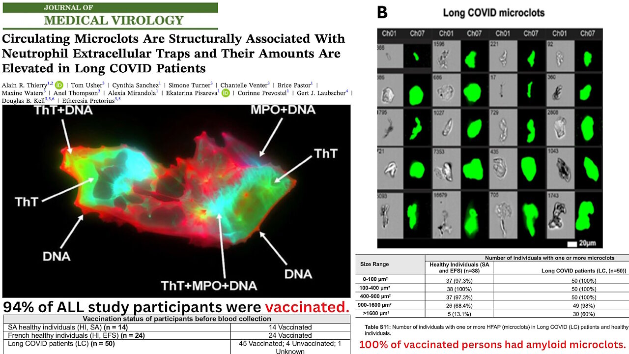 BREAKING STUDY Anomalous Amyloid Microclots Found in 100% of the COVID-19 Vaccinated 2025-11-30
