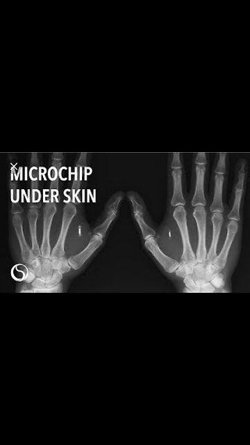 RFID MICROCHIP UNDER YOUR SKIN.(MOTB)…”to receive a mark in their right hand, or in their foreheads” 🕎Luke 20:25 “Render therefore unto Caesar the things which be Caesar's”