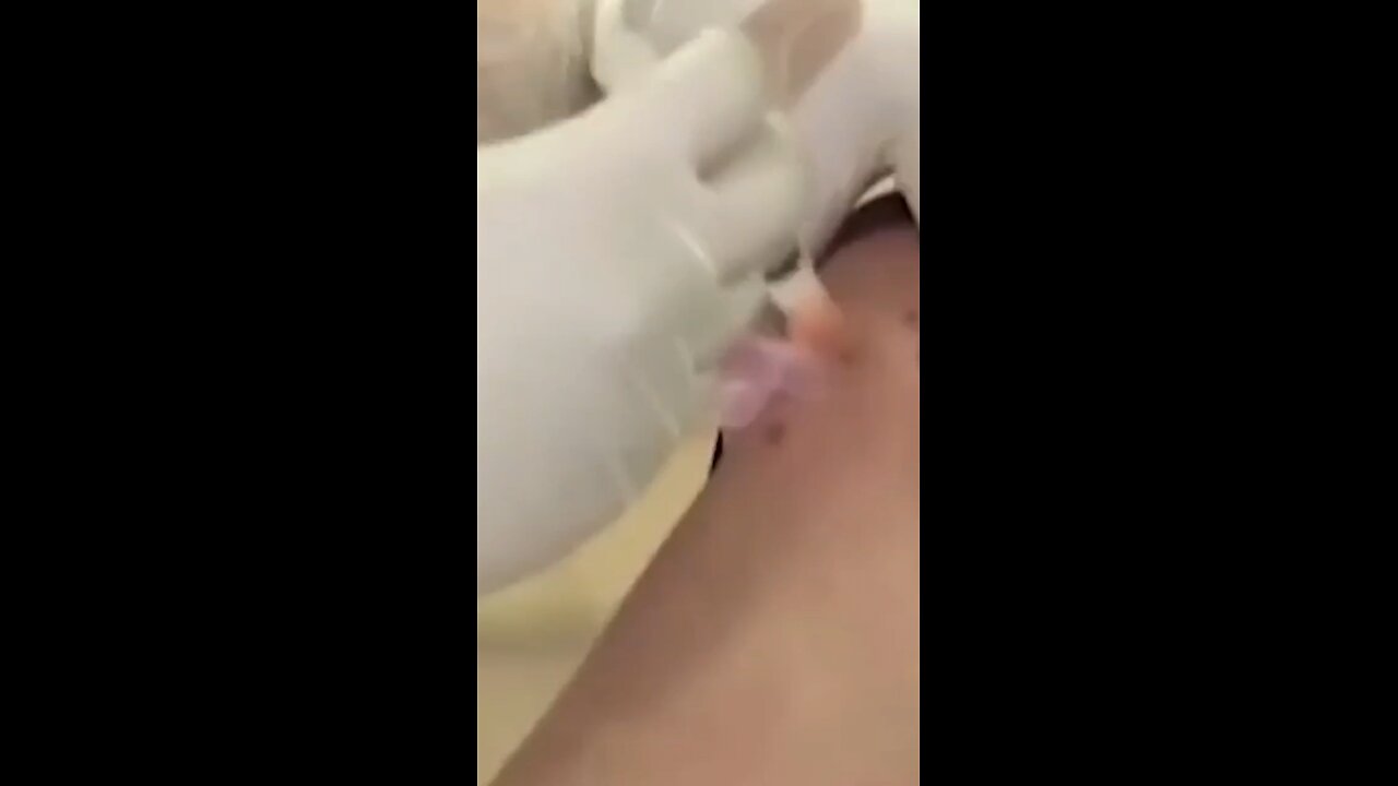 Tree Inoculation
