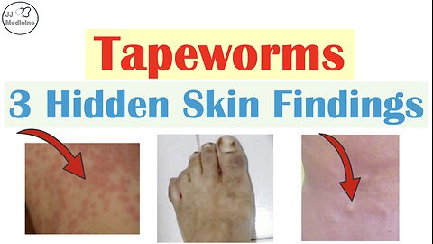 3 Hidden Skin Findings of a Tapeworm Infection