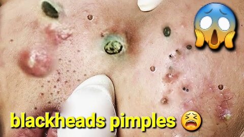 Big Cystic Acne Blackheads Extraction Blackheads , Whiteheads Removal Pimple Popping #blackheads