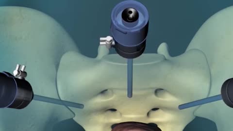 Hysterectomy Procedure 3D Animation
