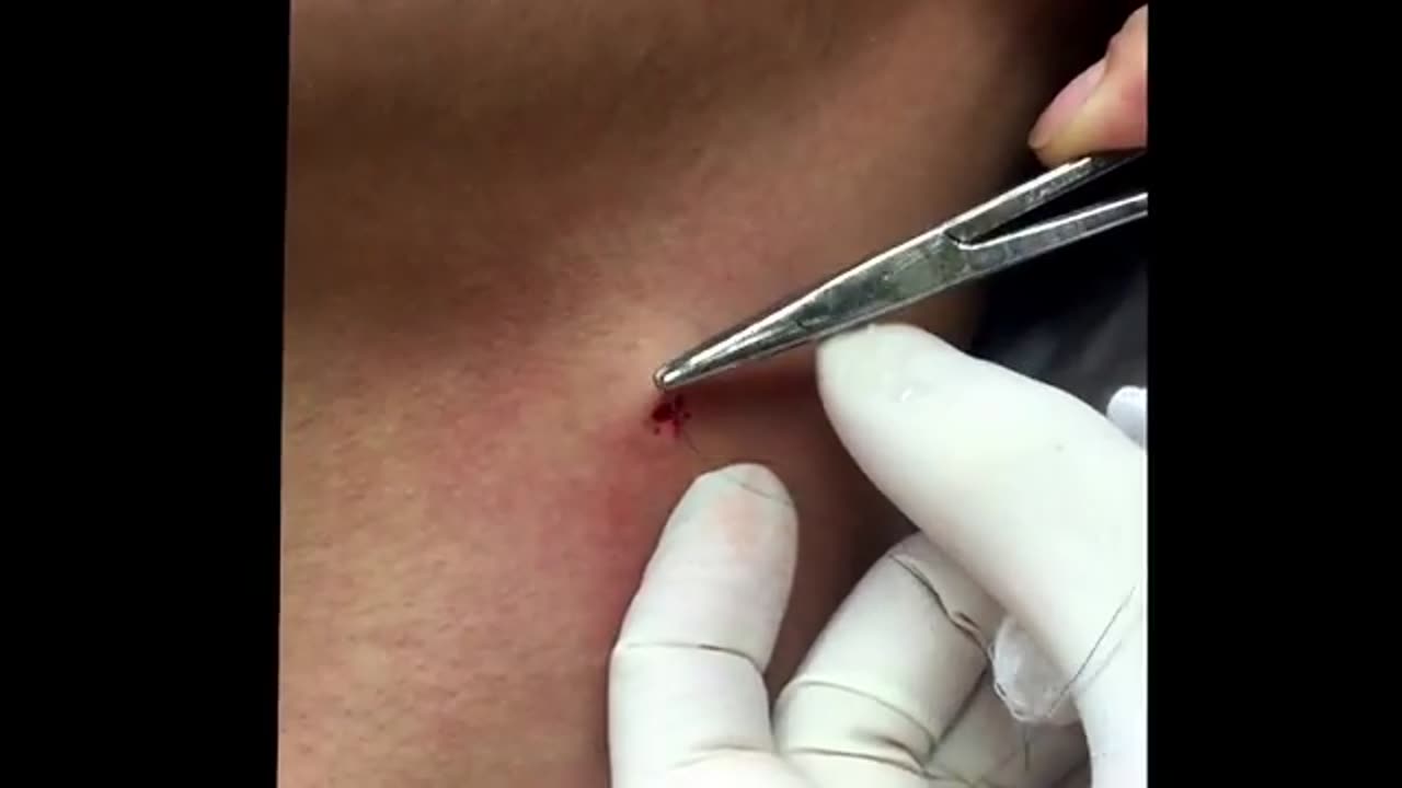 Repost of Punch excision of a blackhead on the neck For medical education NSFE
