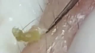 Relaxing Big Cystic Acne Blackhead Extraction Blackheads & Milia, Whiteheads Removal Pimple Poppings