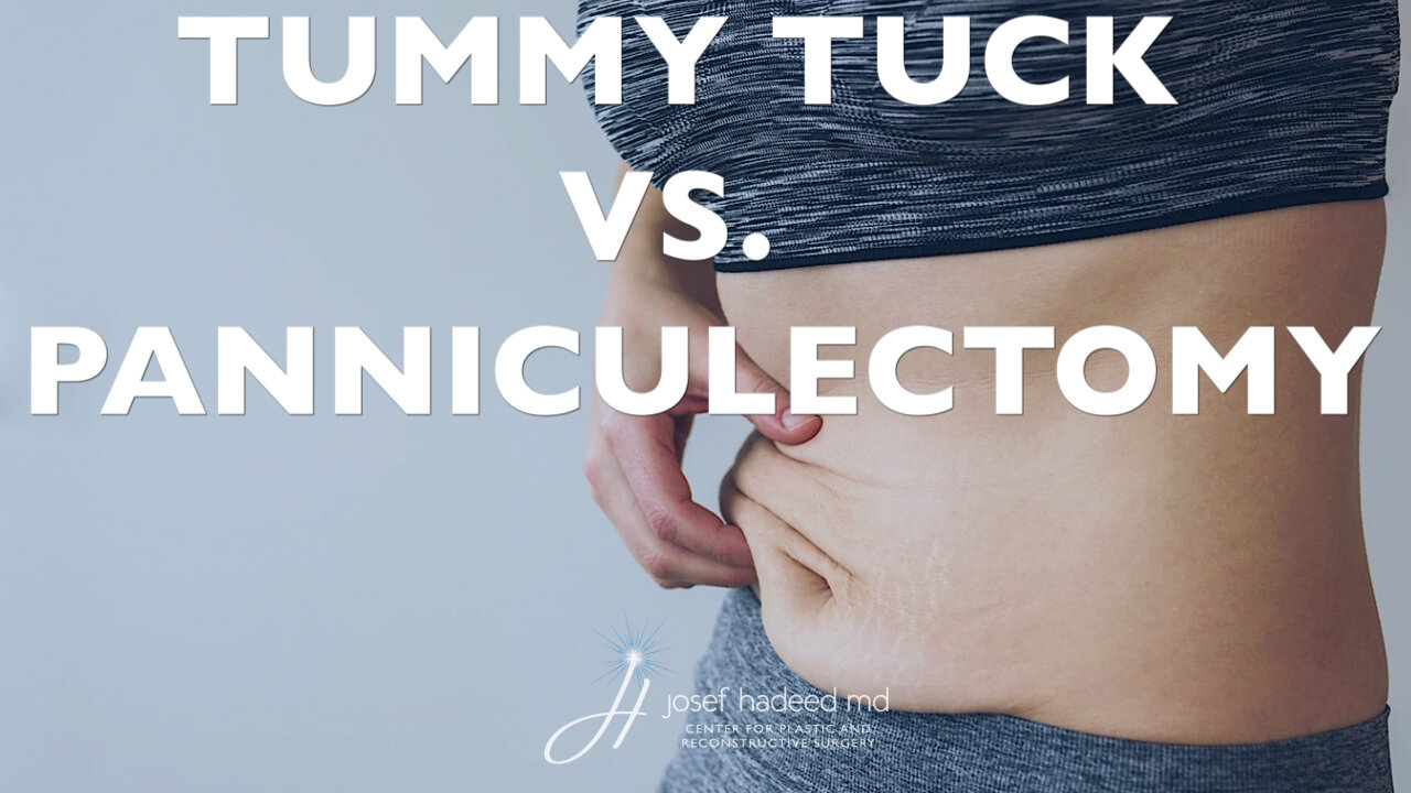 Tummy Tuck vs Panniculectomy