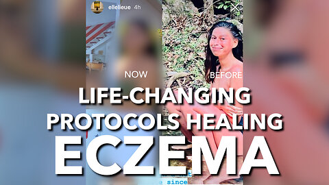 Life-Changing Protocols Healing Eczema