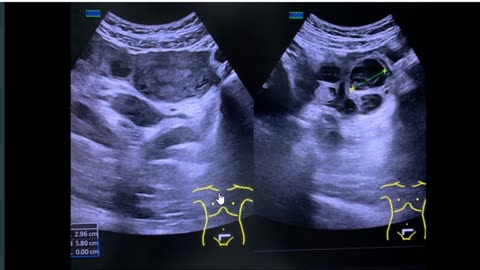 태음인난임환자, 12주까지프로베리,크리논겔 프롤루텍스 프로게스테론이필요 봄에임신, 소음인여름인심아스피린엽산,멜라토닌, 겨울임신소양인코큐텐필요, 소금농도유지,