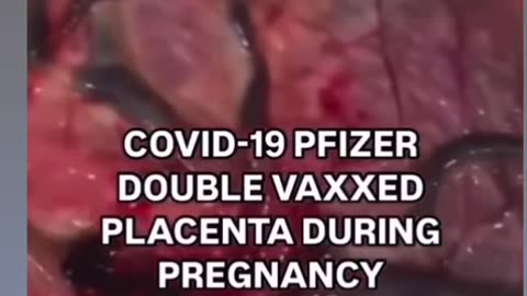 What Does A Vaccinated Persons Placenta Look Like Compared to a Healthy Placenta