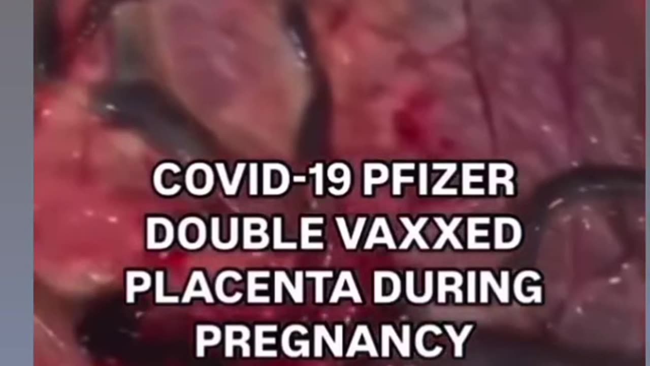 What Does A Vaccinated Persons Placenta Look Like Compared to a Healthy Placenta