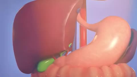 Liver Transplant Surgery 3D Animation