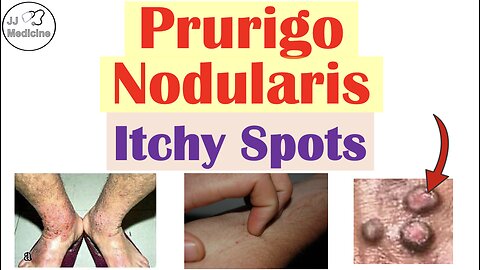 Prurigo Nodularis (Itchy Nodules) | Causes, Pathophysiology, Symptoms, Diagnosis, Treatment