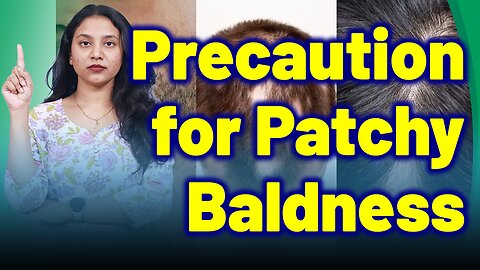 Preacutions for Alopecia Areata, Patchy Baldness | Treatment and Cure| Homeopathy Medicine & Surgery