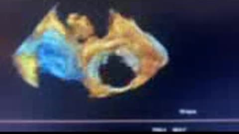 What is a myxoma?