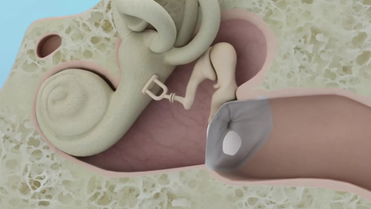 Eardrum Hole Repair Surgery 3D Animation
