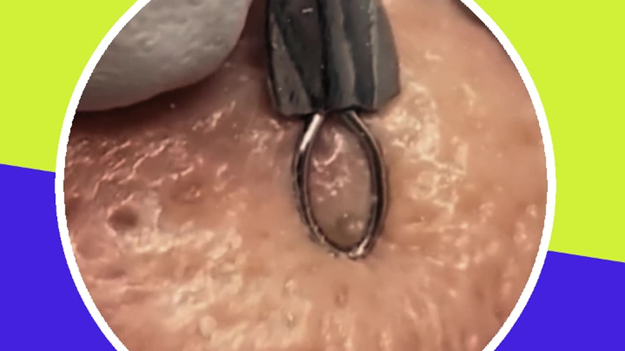 Pimple removal satisfying video (ASMR) #11 #shorts