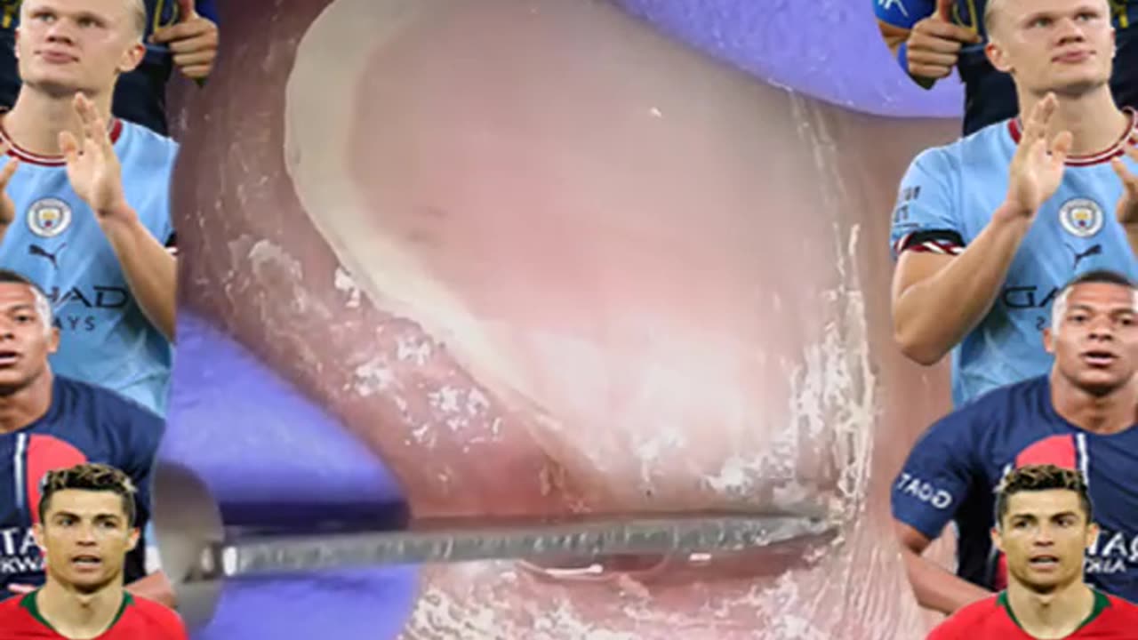 Cleaning is very needed! Home Service Pedicure Series #ingrowntoenail #toenails #pedicure (10)