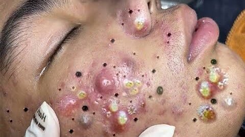 Full length blackhead removal videos #01