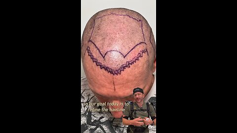 Patient from Michigan After 2 Failed FUTs at Other Clinics