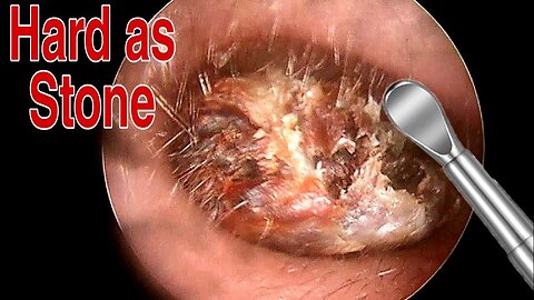 BIGGEST Ear Wax, Difficult Removal - EP5