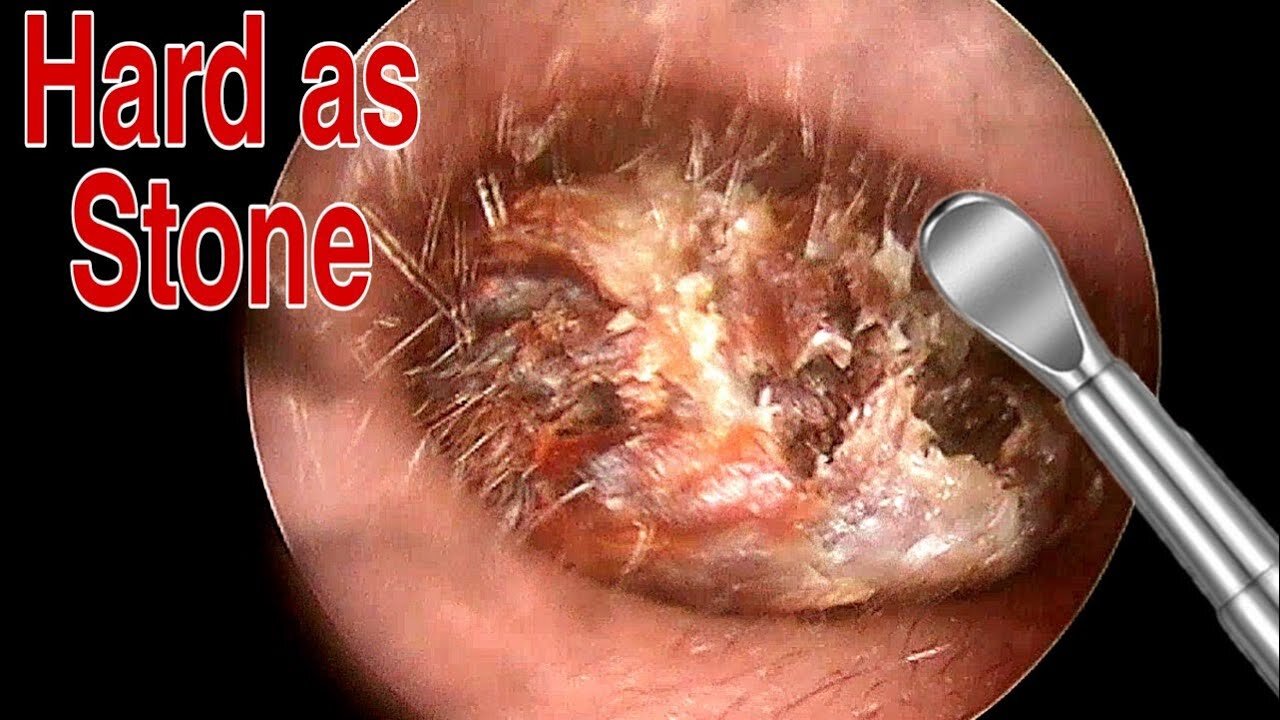 BIGGEST Ear Wax, Difficult Removal - EP5