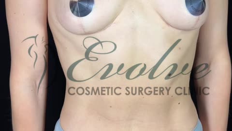 1.5 Years After T-Shaped Breast Lift Without Implants: Real Anatomical Results @evolvecosmeticclinic