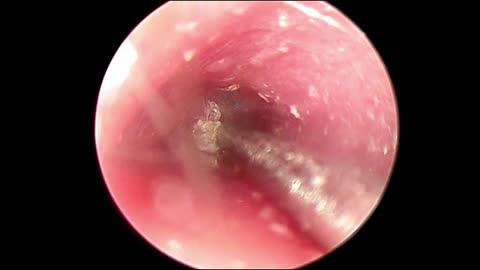 Difficult Ear Wax Removal Close To The Eardrum