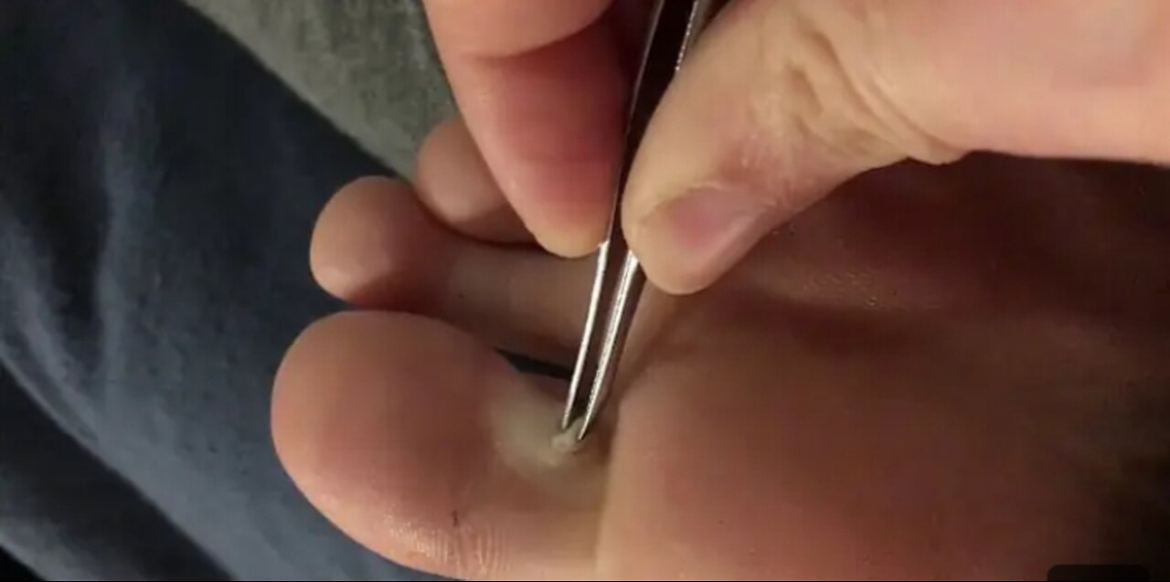 Satisfying Wart Removal