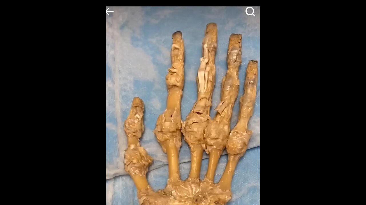 how fingers moves in real#bone#BoneHealth#BoneCare#StrongBones#BoneStrength#BoneHealing#BoneInjury