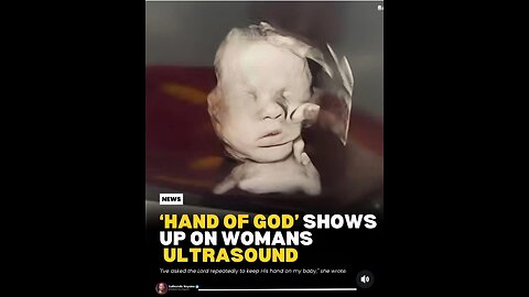 The 'Hand of God' That Appeared in an Ultrasound