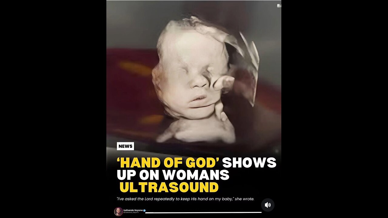 The 'Hand of God' That Appeared in an Ultrasound