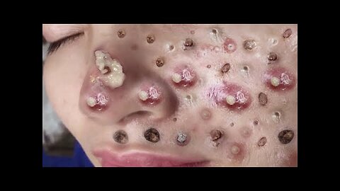 Blackheads Removal & Pimple Popper Cystic Acne Extraction 7