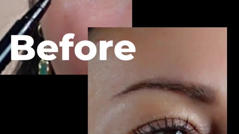 Botox near Lash line - for Crepey Skin