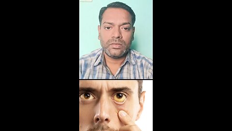 क्या हेपेटाइटिस सी की बीमारी ठीक हो सकती है ।