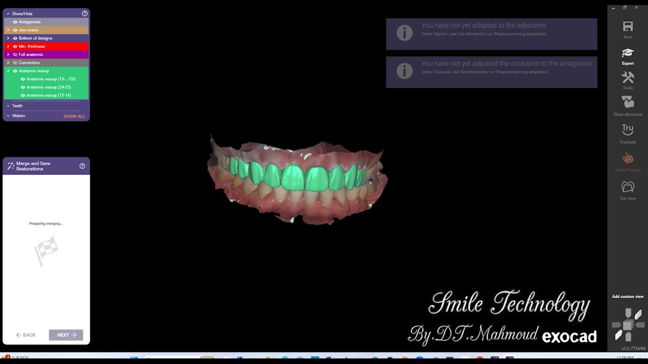 #design #naildesign #dental #dentaldesign #exocadexpert